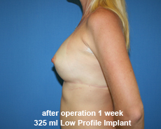 plastic-surgery-breast-augmentation
